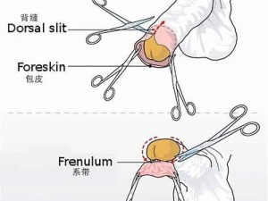 真实呈现：成年男生割包照片，了解割包手术全过程